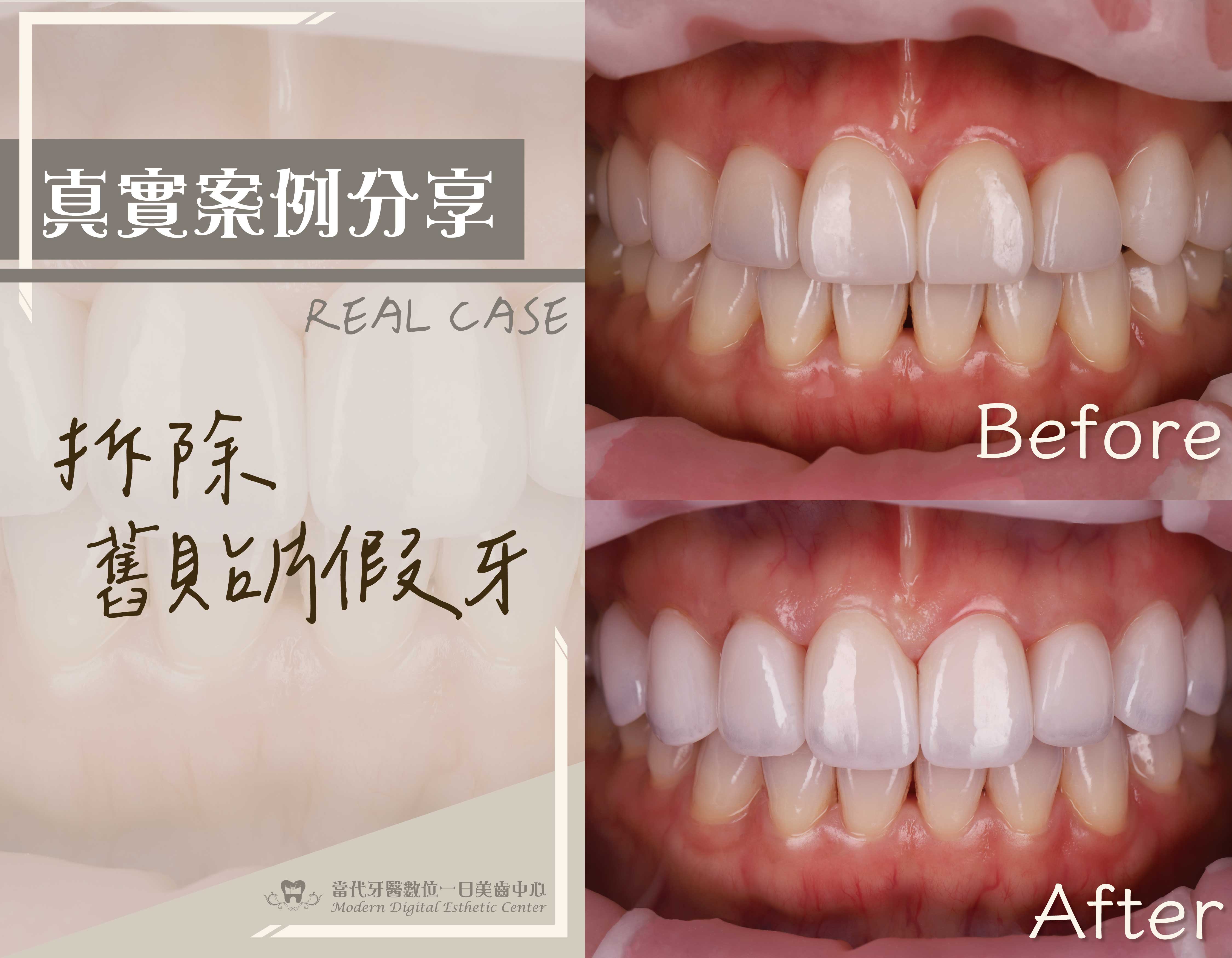 拆舊貼片、假牙