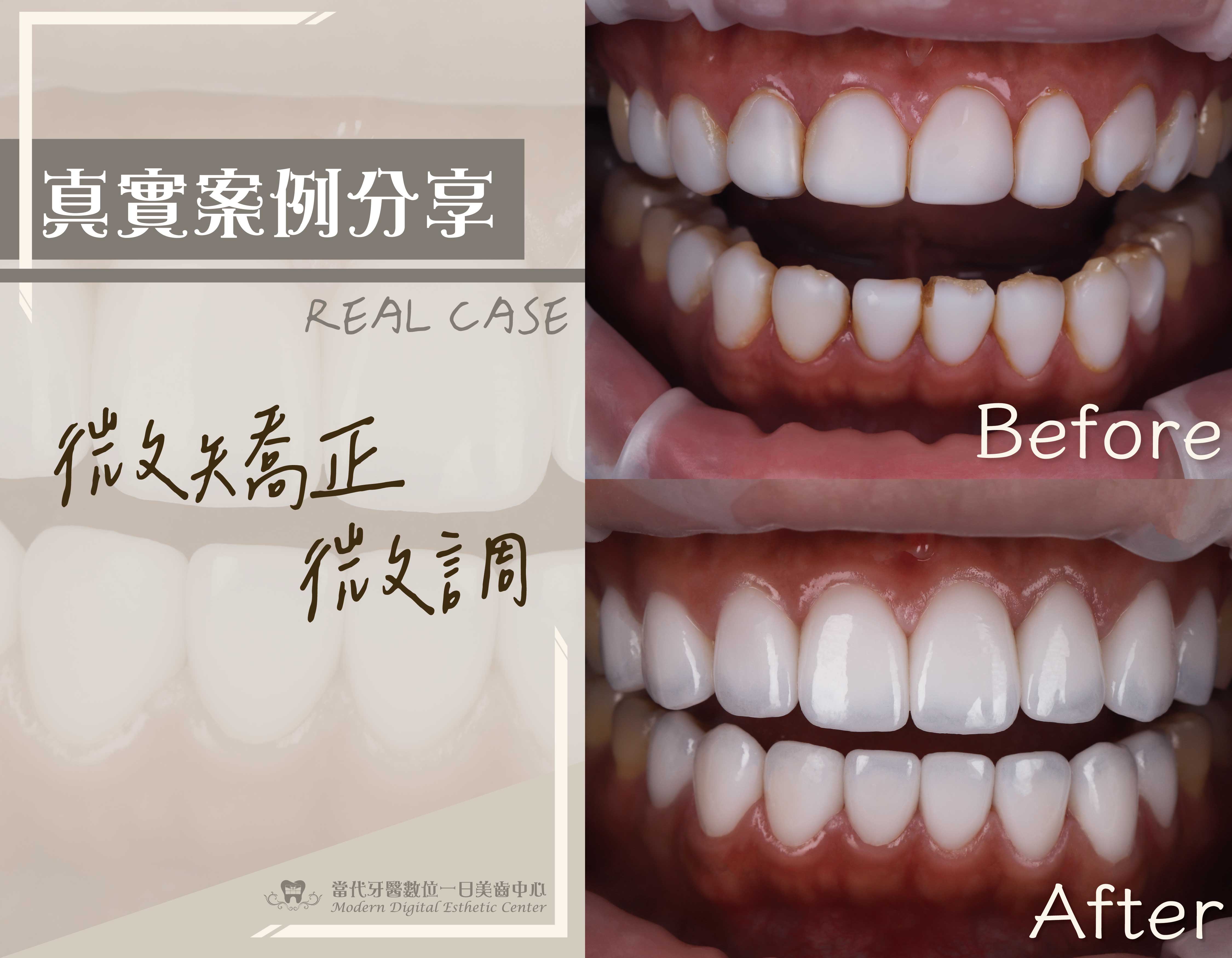 微矯正、微調排列