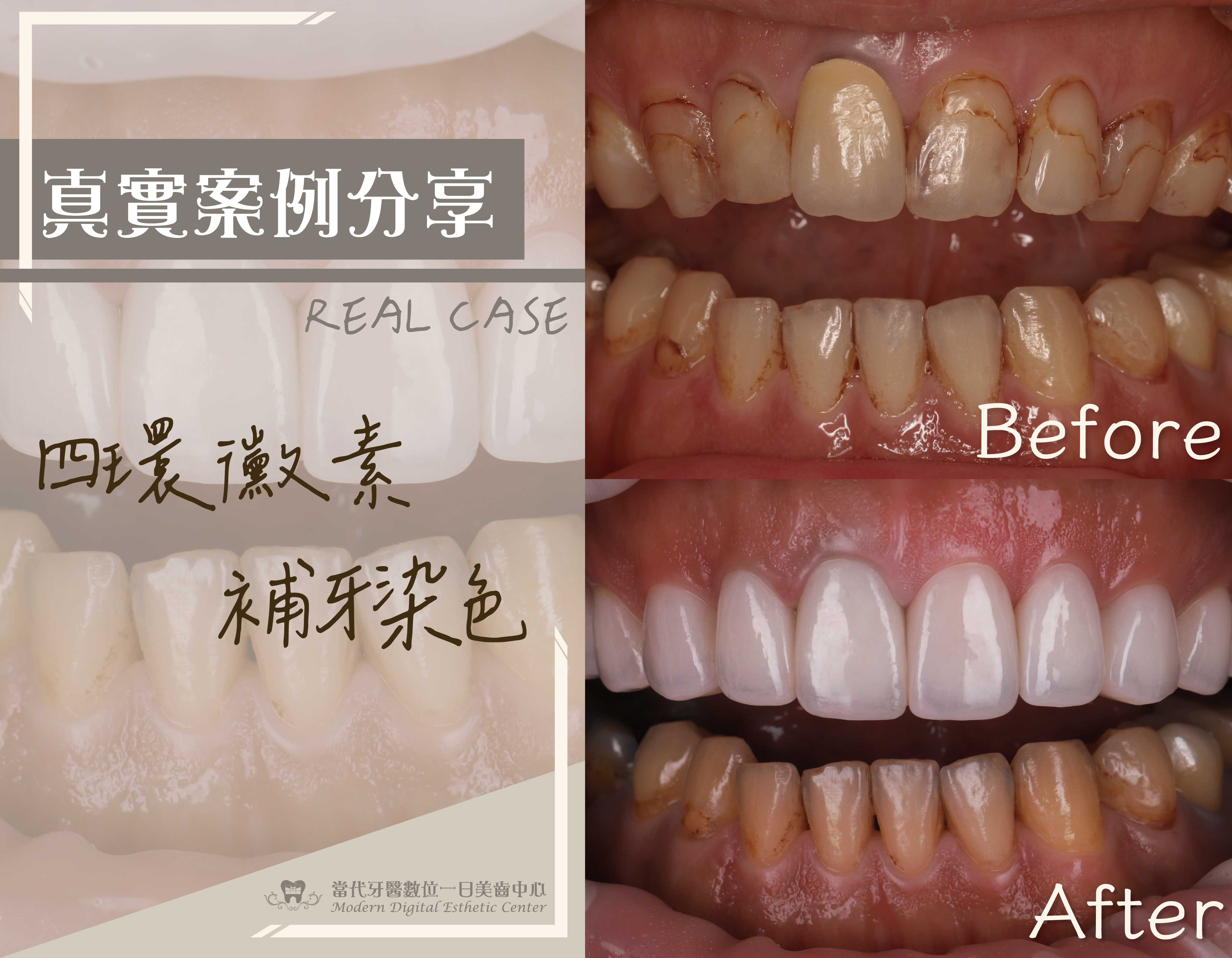 四環黴素、補牙染色