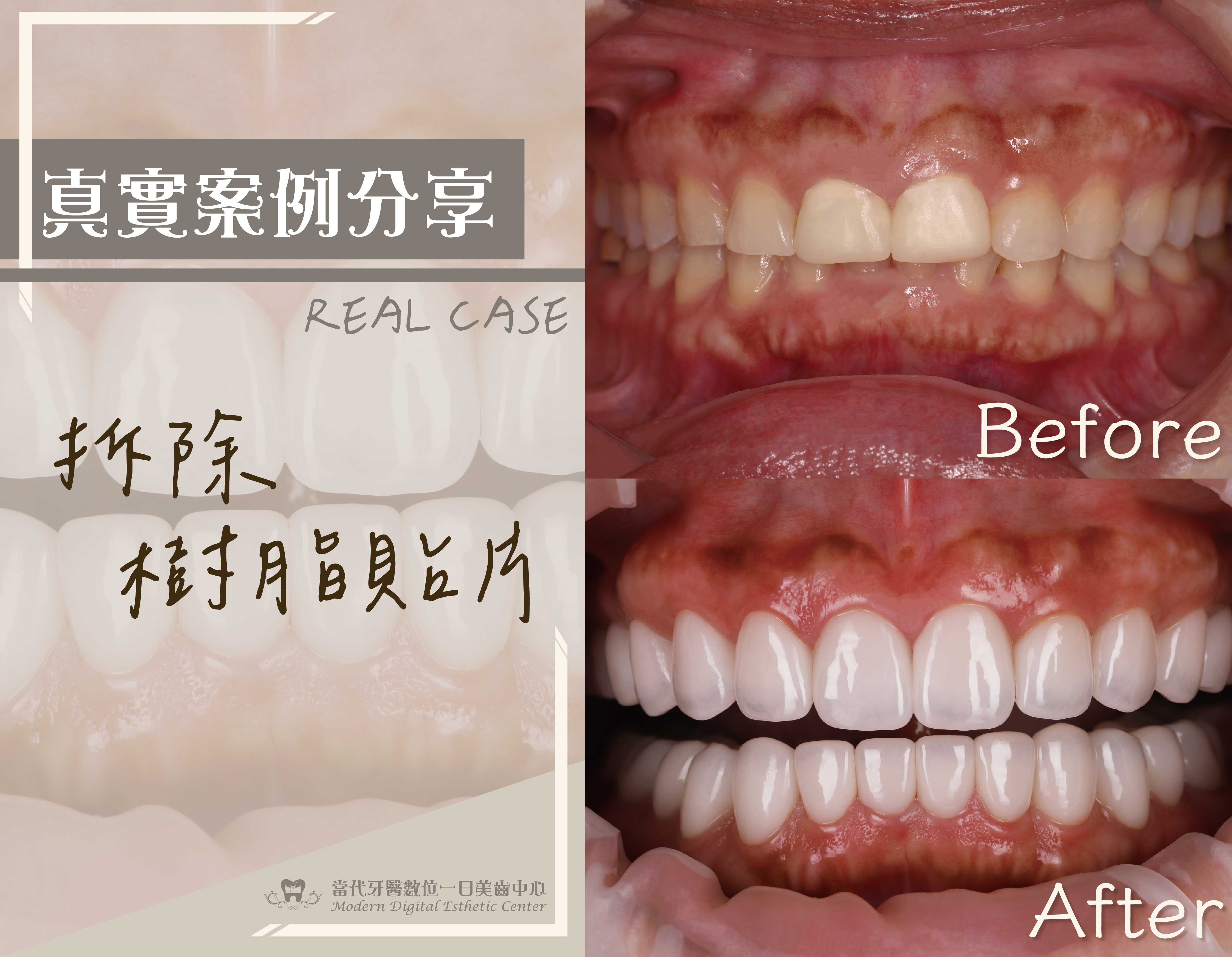 全口重建、牙齒磨耗