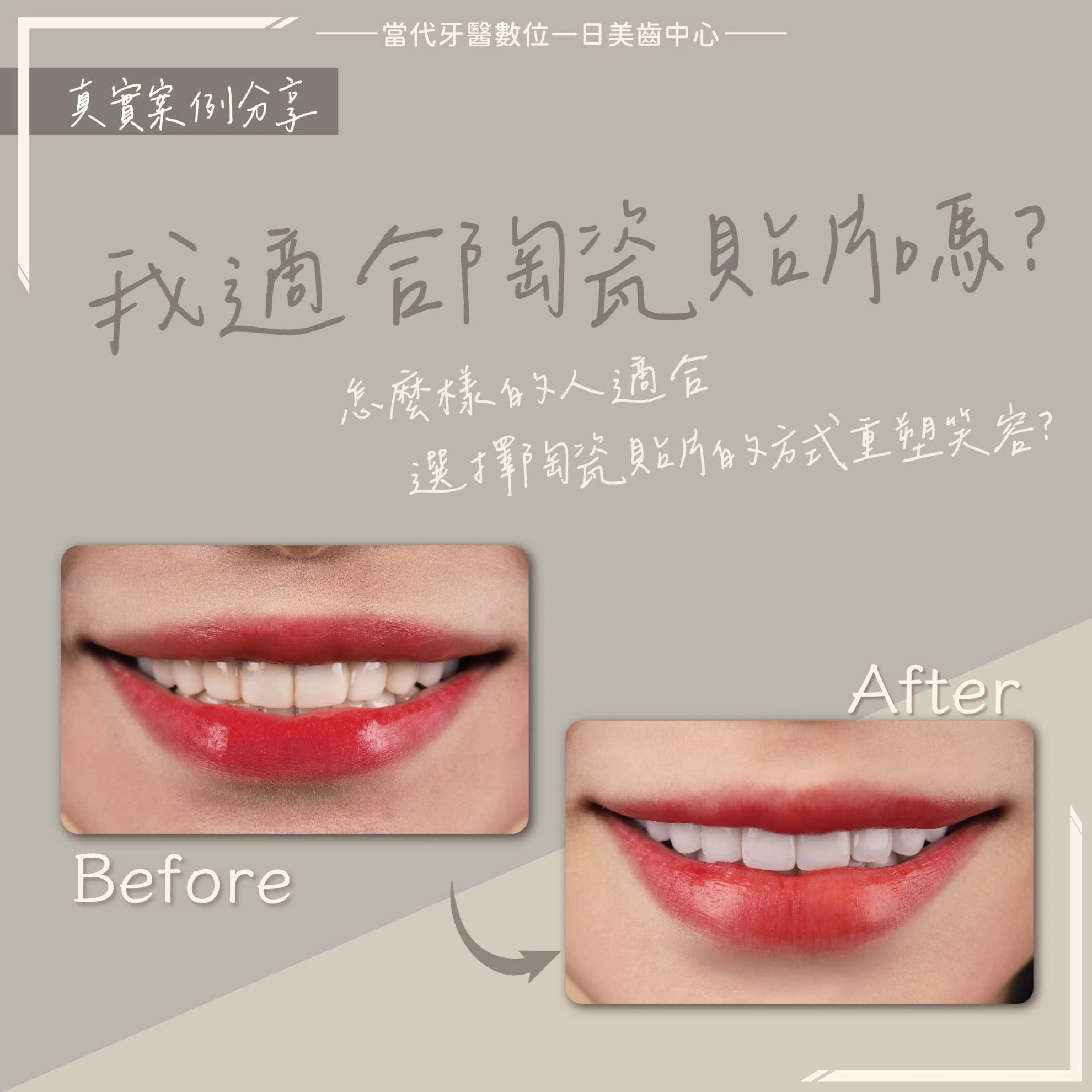 拆舊貼片-我適合陶瓷貼片嗎 拆舊貼片-我適合陶瓷貼片嗎