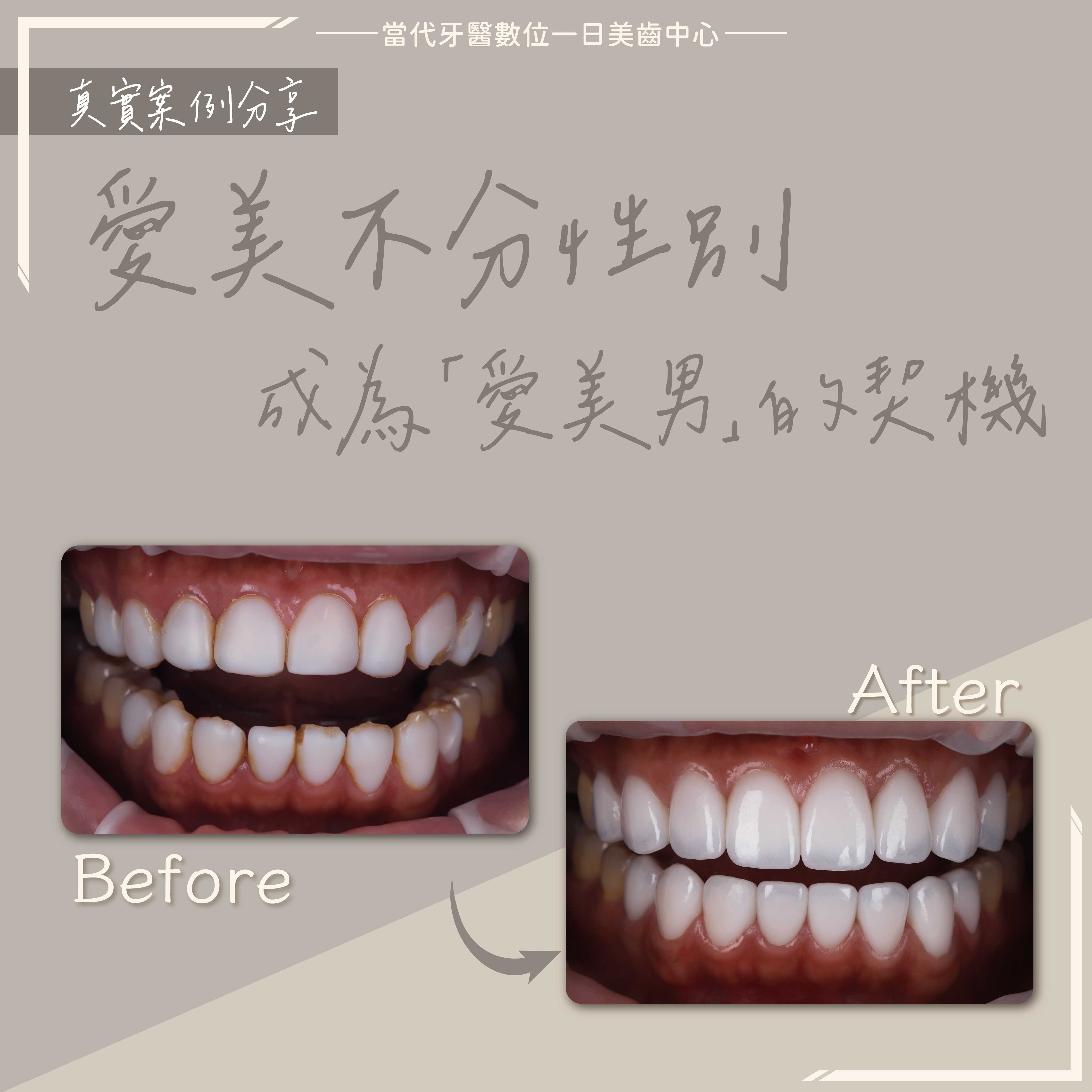 拆樹脂貼片-愛美不分性別 拆樹脂貼片-愛美不分性別