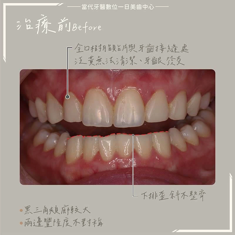 拆樹脂貼片-便宜貼片的危害 拆樹脂貼片-便宜貼片的危害