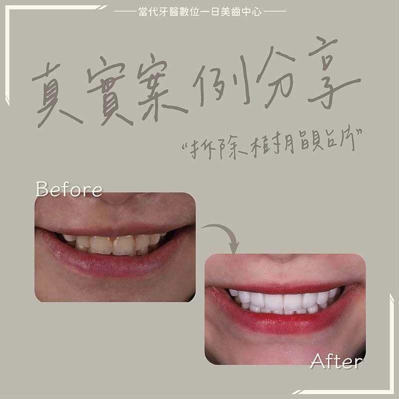 拆樹脂貼片-便宜貼片的危害 拆樹脂貼片-便宜貼片的危害