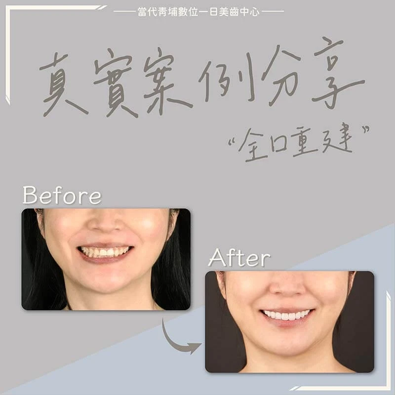 全口重建 - 案例1