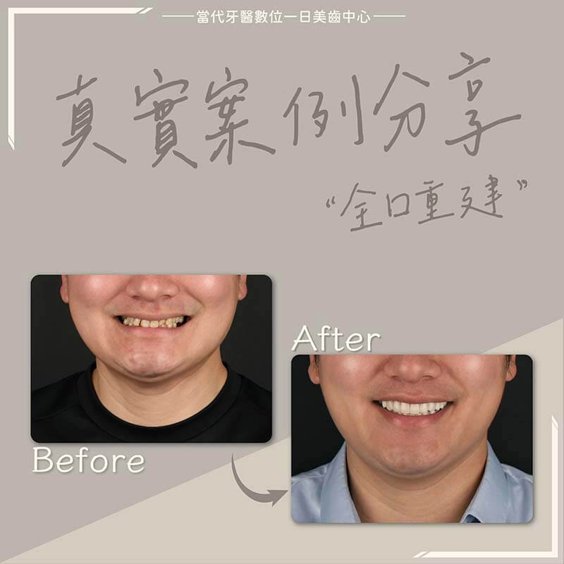 全口重建 - 案例2