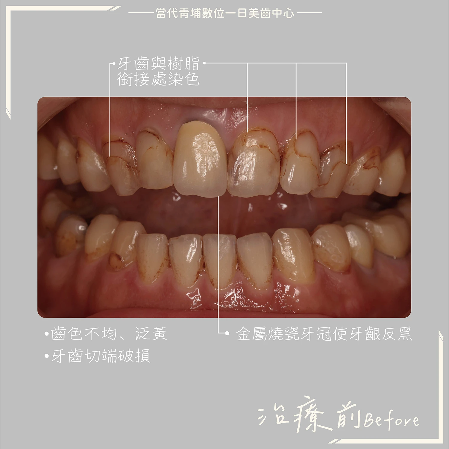 proimages/in-pro/pro-02/case-07.jpg proimages/金屬假牙換新假牙.jpg