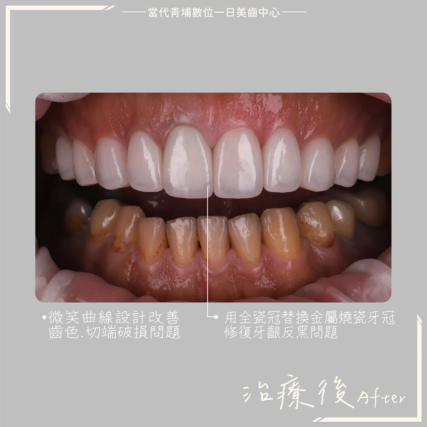 proimages/in-pro/pro-02/case-08.jpg proimages/金屬假牙換新假牙.jpg