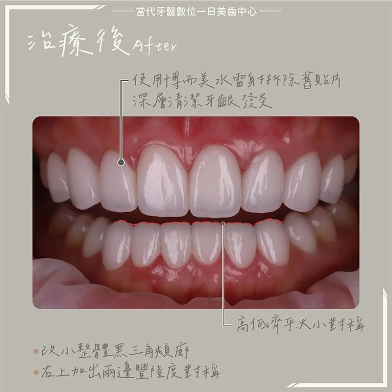 proimages/in-pro/pro-02/case-10.jpg proimages/金屬假牙換新假牙.jpg