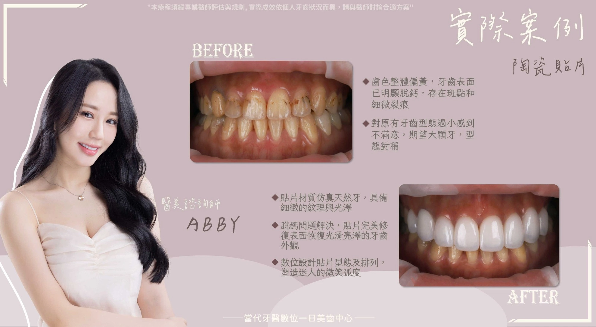 Abby |傳統矯正帶來的隱藏遺憾 Abby |傳統矯正帶來的隱藏遺憾