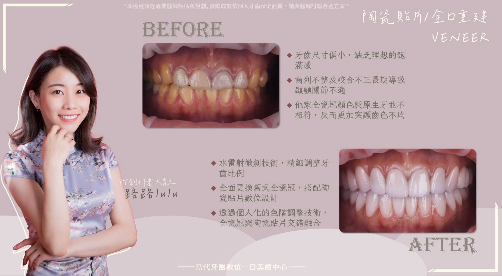 路路Lulu| 全口重建迎接第二人生 路路Lulu| 全口重建迎接第二人生