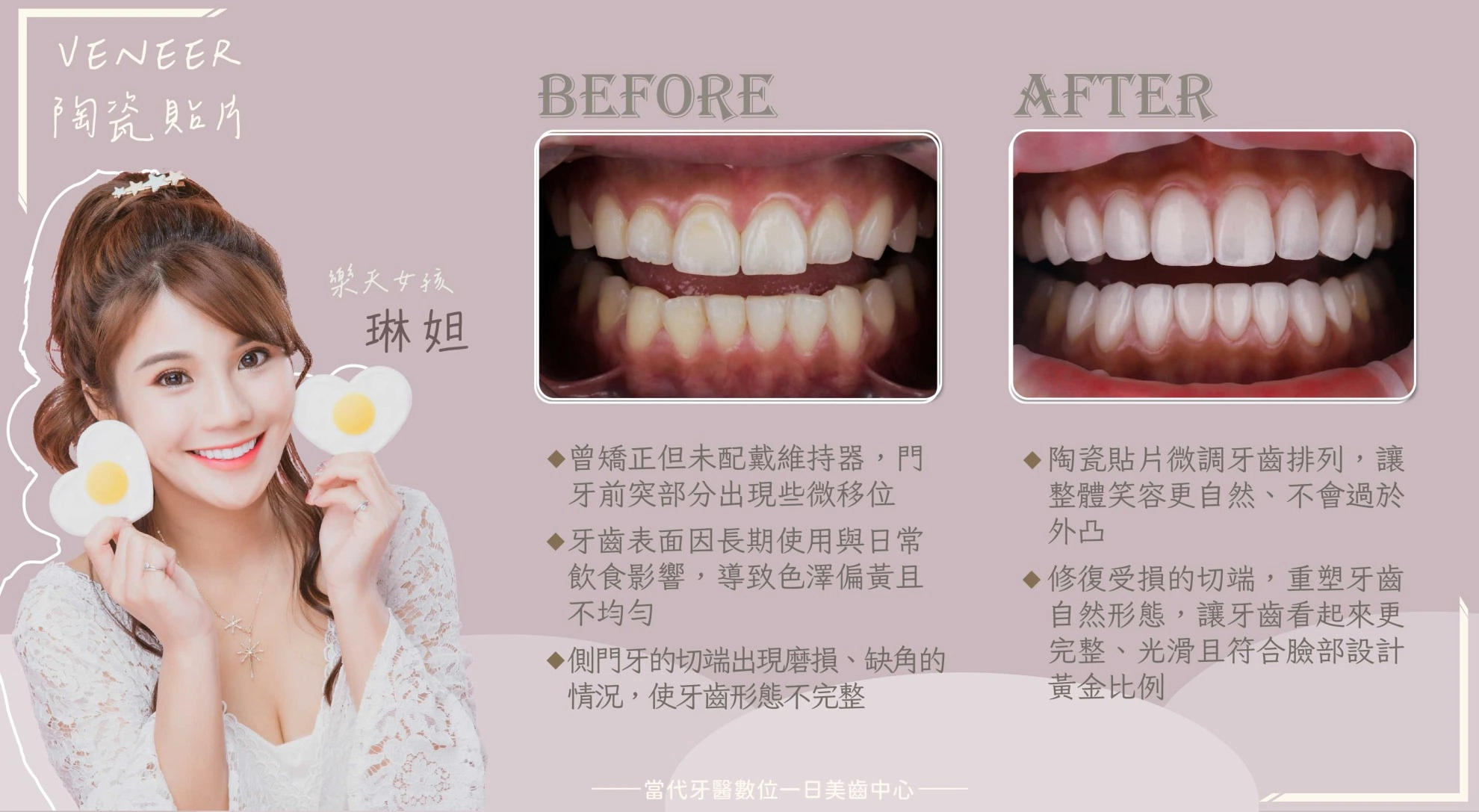琳妲 | 貼片成為完美解方 琳妲 | 貼片成為完美解方