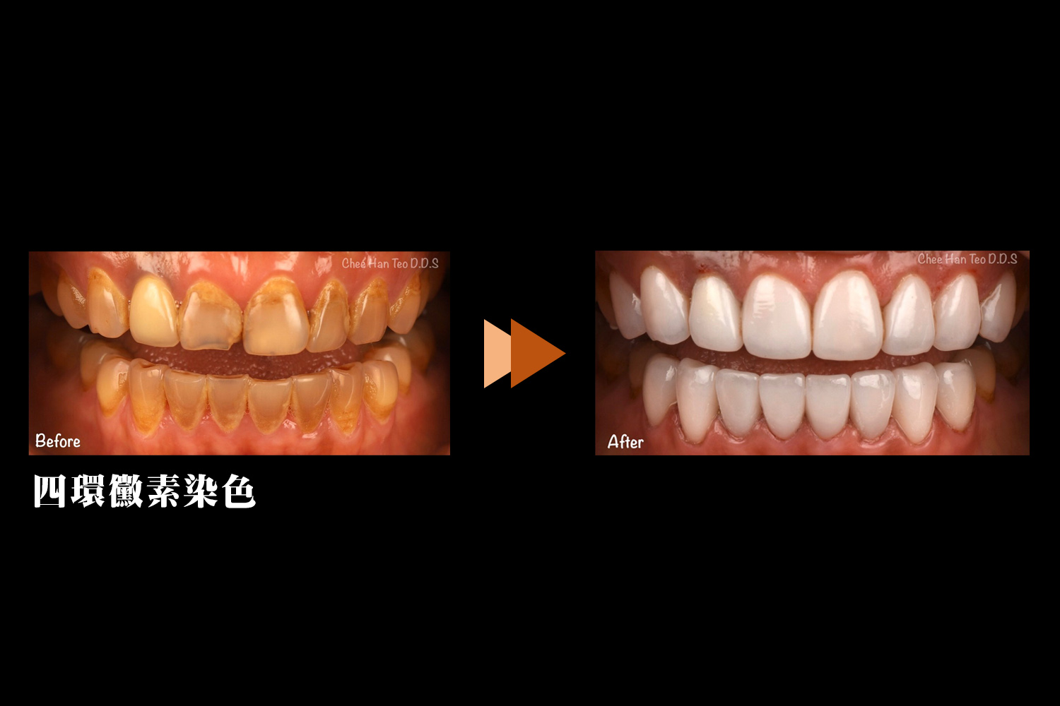 proimages/四環黴素染色.jpg proimages/四環黴素染色.jpg