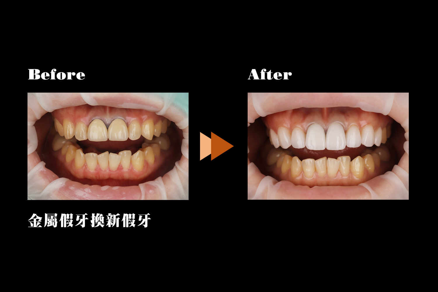 proimages/金屬假牙換新假牙.jpg proimages/金屬假牙換新假牙.jpg