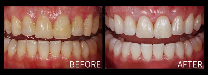 冷光美白前後對照圖 冷光美白前後對照圖