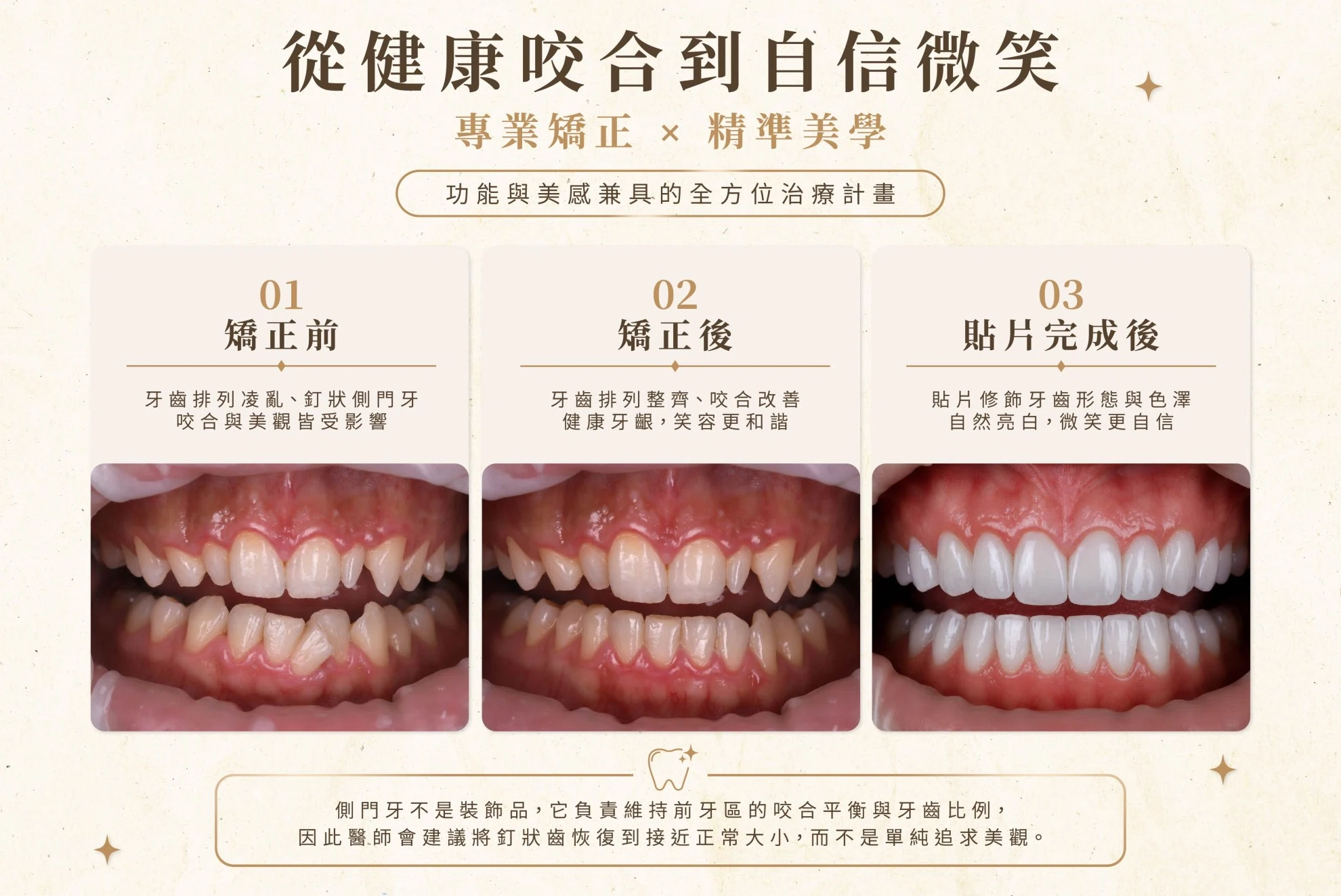 釘狀齒 - 牙齒裡的隱藏角色 釘狀齒 - 牙齒裡的隱藏角色
