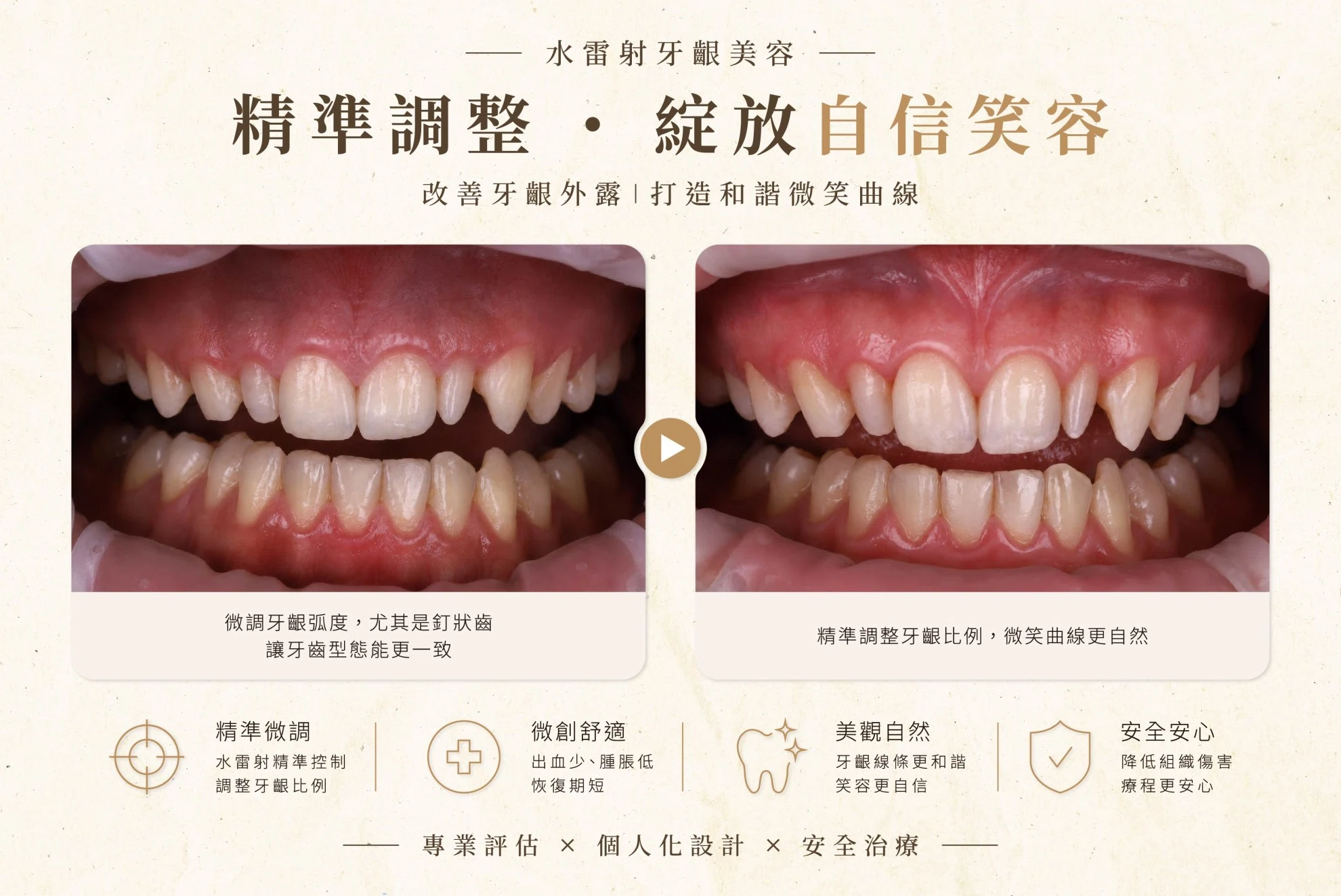 釘狀齒 - 牙齒裡的隱藏角色 釘狀齒 - 牙齒裡的隱藏角色